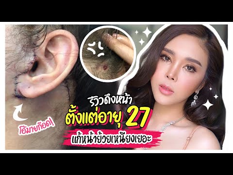 เติมของ EP.2 | ดึงหน้า แก้หน้าย้วยเหนียงเยอะได้จริงหรอ?