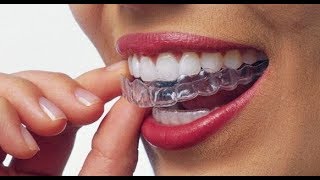 ЭЛАЙНЕРЫ ДЛЯ ЗУБОВ. ЧТО ТАКОЕ ЭЛАЙНЕРЫ? Комментарий стоматолога. Капы для зубов. Ортодонтия 🦷