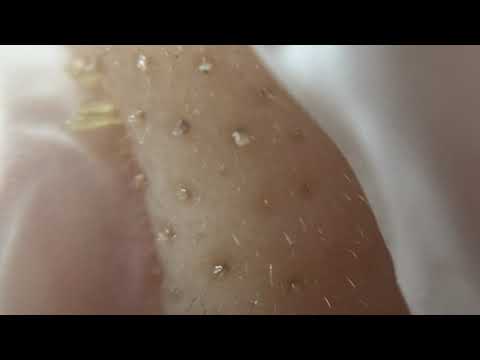 Black Heads 2 角栓ニョロニョロ Keratin Plug Microscope Youtube