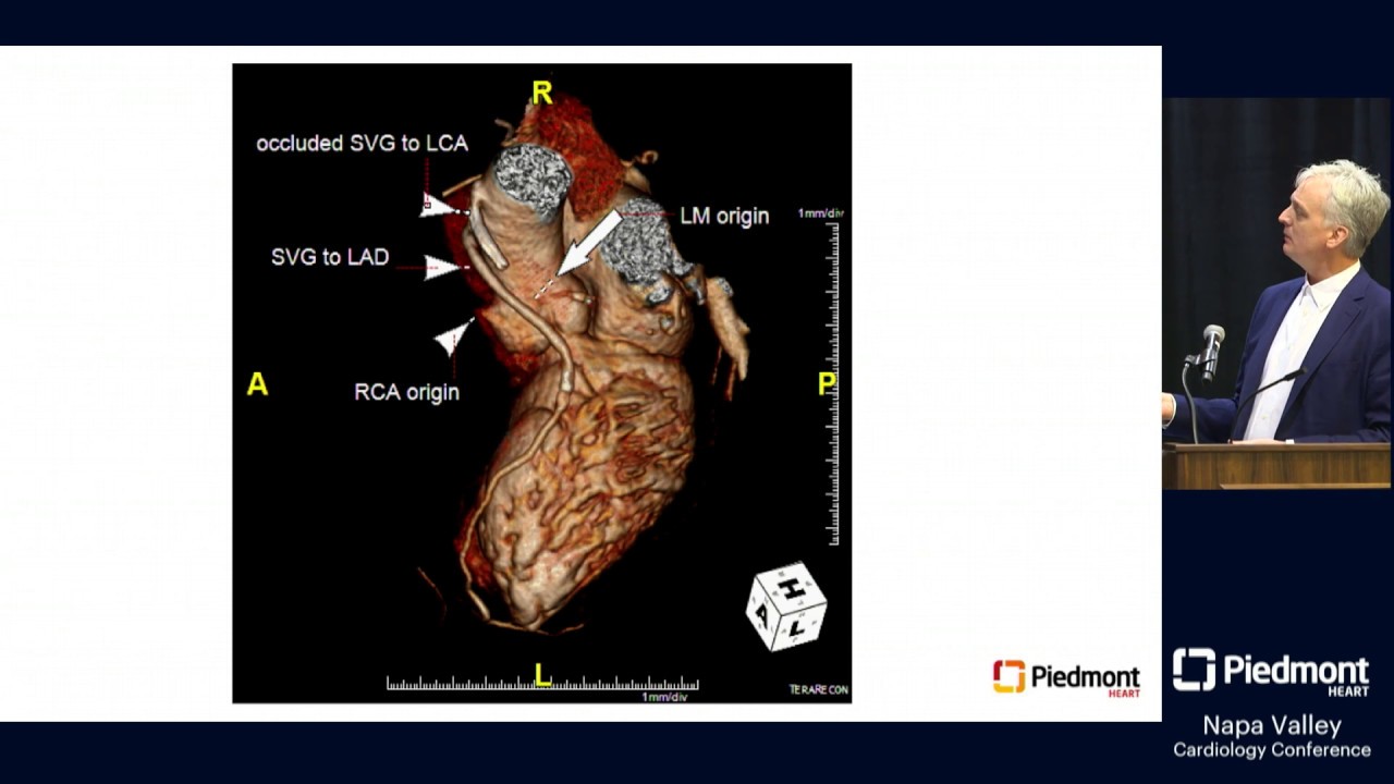 CTO Revascularization: Appraisal of Successes and Shortfalls