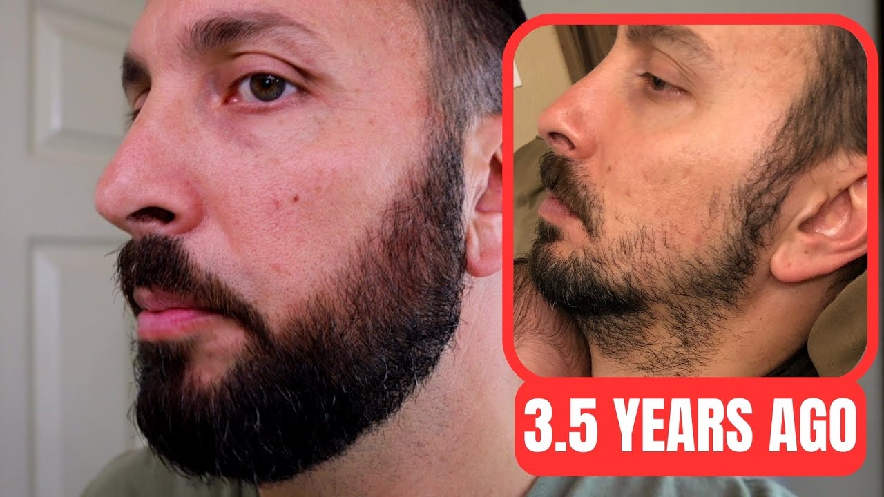 Minoxidil Beard Journey 3.5 Years Later | How To Grow A Real Beard ...