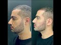 Reversing incorrect placed filler and refill using the correct Technique with Dr.Firas Hamdan