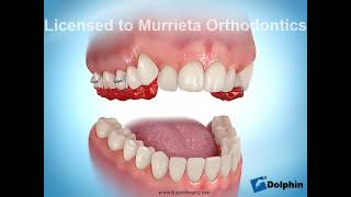 Murrieta Orthodontics Anterior Crossbite Appliance