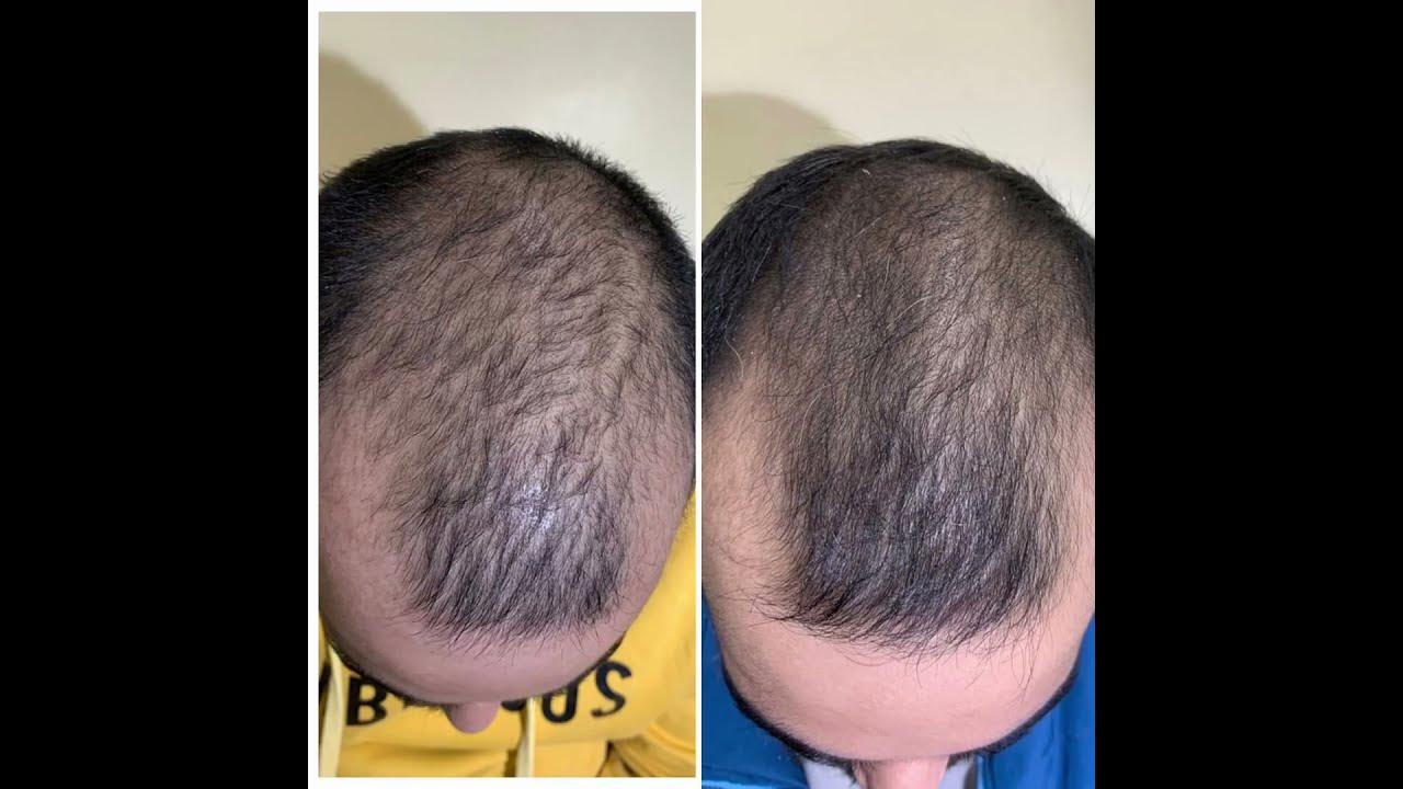 Hair loss treatment results in males and female after 3 to 6month of treatment YouTube