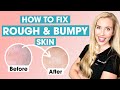 How To Fix Rough and Bumpy Skin | Keratosis Pilaris Affordable Skincare Routine