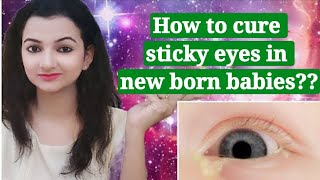 Blocked tear Duct in infants || Sticky Eyes in New born Babies || How to clean sticky eyes in infant