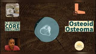 Osteoid Osteoma - Everything You Need To Know - Dr. A B Govindaraj Mgmhelathcare