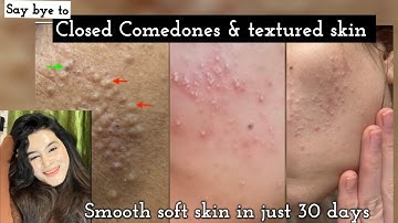 Remove stubborn texture Closed comedones ; smooth soft skin in just 30 days ; guranteed results ❣️