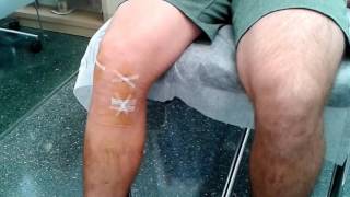 Cesar Portas kitesurf injury ACL Allograft reconstruction | Doctor Christian Wilches