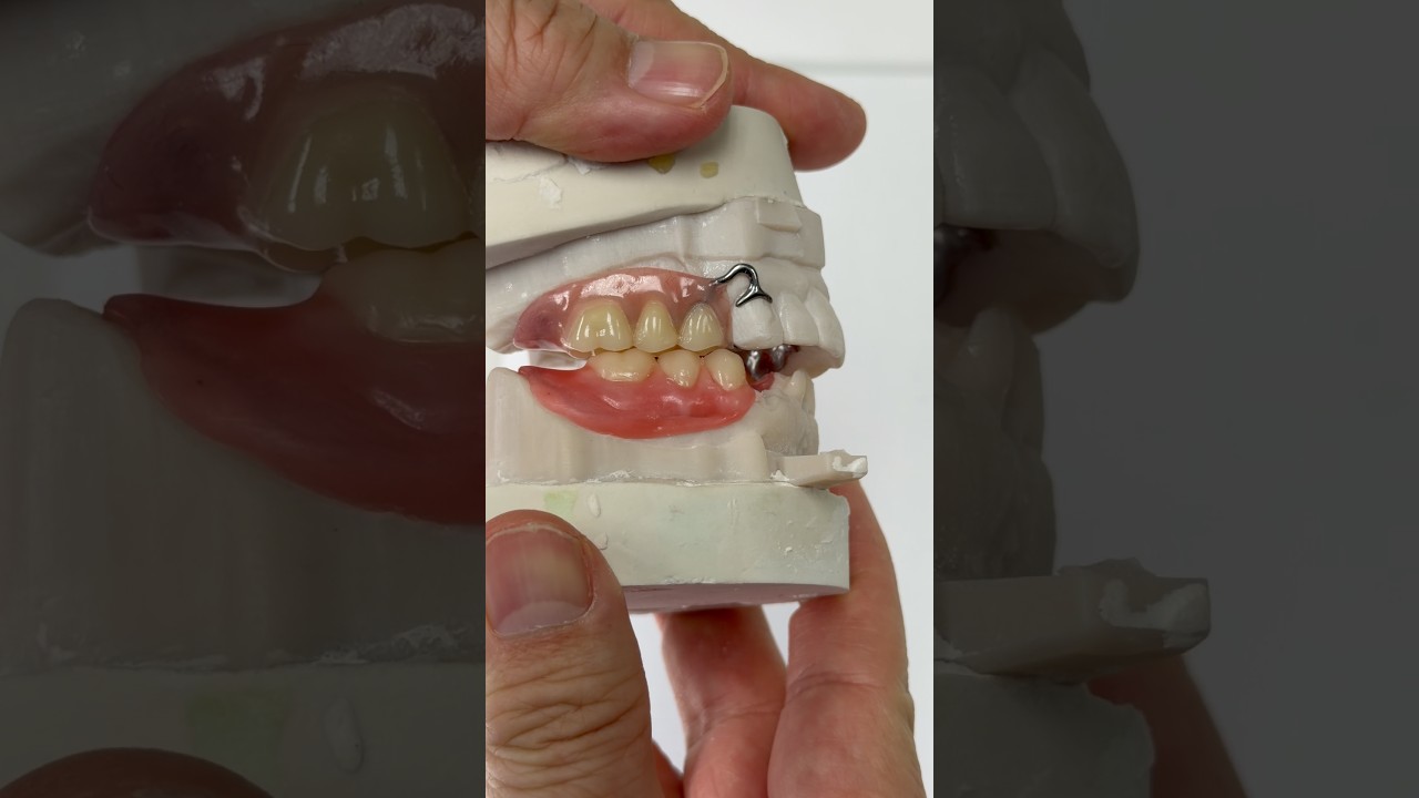 Metal partial upper with lower wax try-in for Dr.Todd Sheffler in New Hampshire