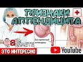 💊  5 СИМПТОМОВ АППЕНДИЦИТА