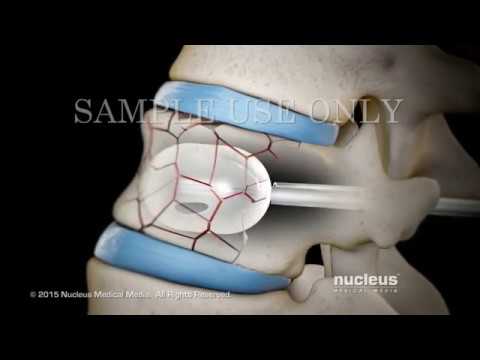 Вертебропластика , кифопластика позвоночника