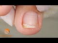 Nail trimming is not easy for her | Cleaning nails for comfort and relief to many hours of work