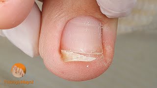 Nail trimming is not easy for her | Cleaning nails for comfort and relief to many hours of work
