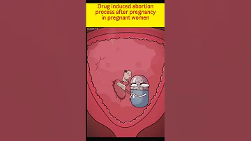 Drug induced abortion process after pregnancy in pregnant women #asmr #shorts