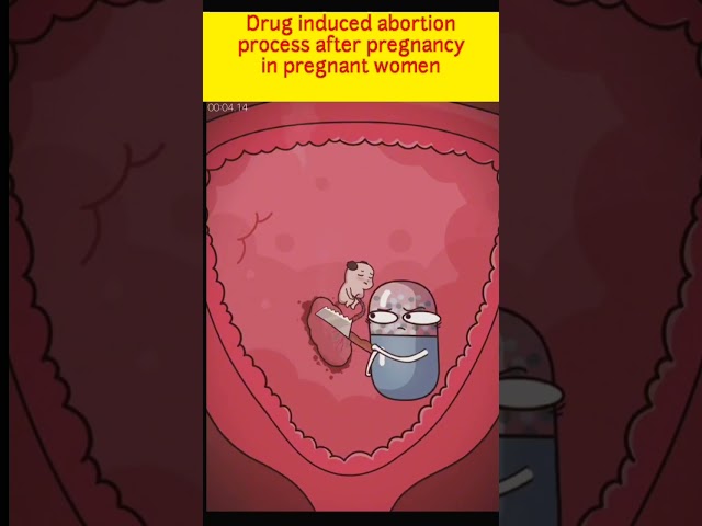Drug induced abortion process after pregnancy in pregnant women #asmr #shorts class=
