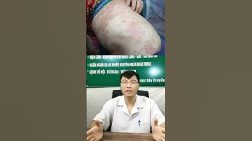 Điều Trị Hắc Lào Bằng Củ Riềng Có Đáng Tin Không? Góc Nhìn Khoa Học