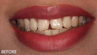 Smile Makeover - Ideal Smile