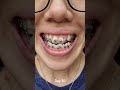 Update My 7 Months Braces Journey Class III Underbite