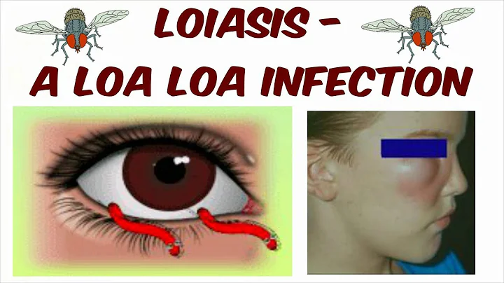 Loiasis - A Loa Loa Infection (The African Eye Worm)