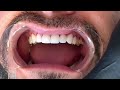 Placement of upper #veneers Lowers pending #smilemakeovers