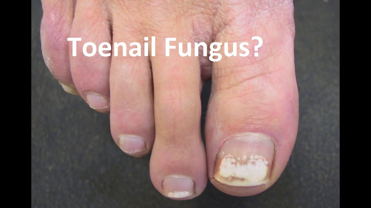 Nail Fungus - Coastal Valley Dermatology