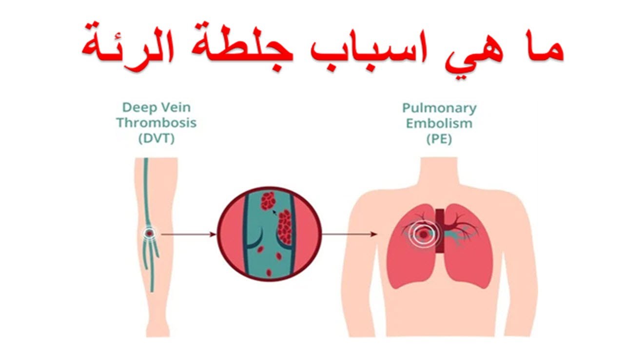 ما هي اسباب جلطة الرئة عوامل الخطر للجلطات الرئوية أسباب جلطات الساق الوريدية العميقة Youtube