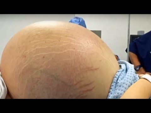 World's Largest Cyst! 130 Pound Cyst Removal Case Study - Surgery