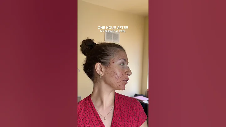 CHEMICAL PEEL RESULTS! Acne transformation! #acne #chemicalpeel #skincare