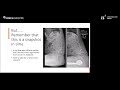 Evolution in pre-op planning- the 3rd dimension | Milne Lachlan (Session 12)