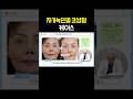 자가늑연골 코성형 케이스 #2 🤔