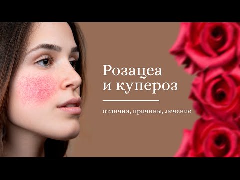 Розацеа и купероз. В чём отличия и как избавиться?