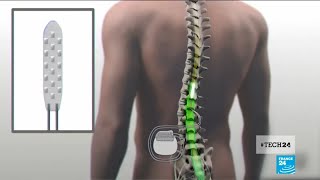 Medical breakthrough: a spinal cord implant helps paralyzed patients to walk again