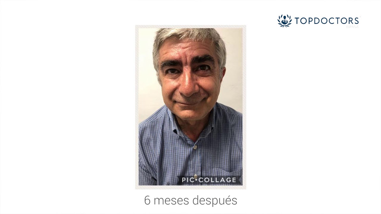 Resultados y beneficios de la Fisioterapia en la parálisis facial top movies on netflix