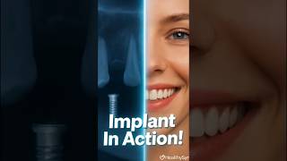 DENTAL IMPLANT SURGERY — Full 3D Animation Explained | Step-by-Step Procedure  #shorts @healthysync