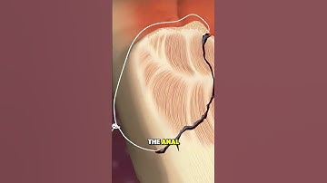 How Fistula Surgery is Done - 3D Animation #fistulasurgery #generalsurgery #colorectalsurgery