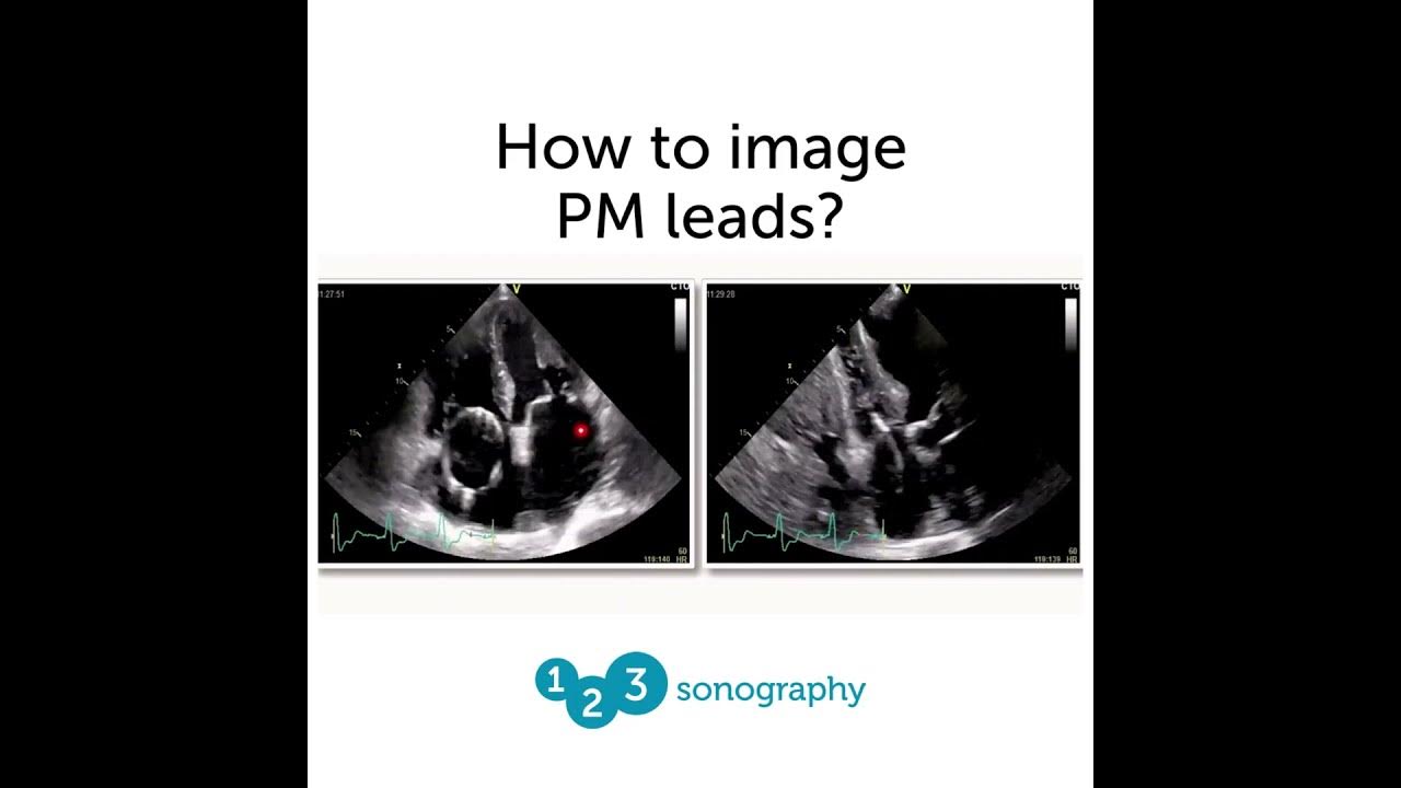 How to image pacemaker leads? 123sonography ultrasound echocardiography sonography 