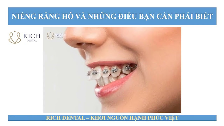 Niềng răng hô thưa bao nhiêu tiền năm 2024