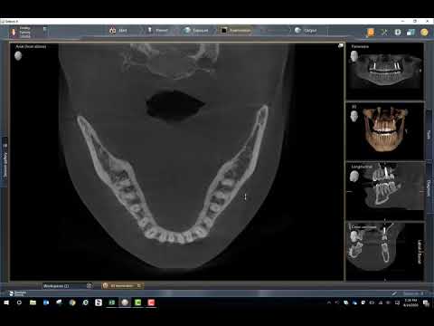 DS 3D- Post Implant Scan. Metal Artifact Reduction.