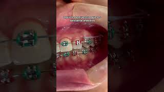 Distalizador efectivo #dentista #dentist #dental #bracket #tips #ortodoncia #doctor #ortodoncista