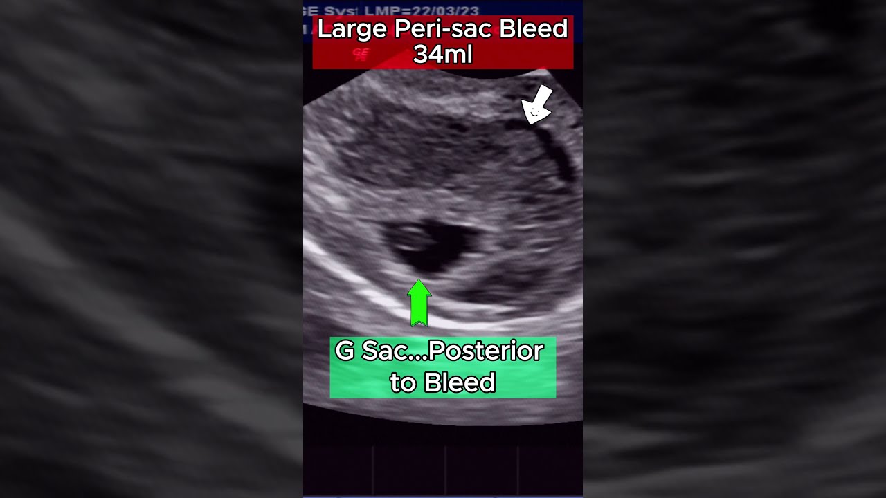 Ultrasound High Risk 6wks Pregnancy With Heavy Bleed