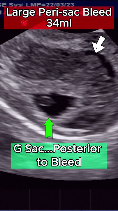 Ultrasound High Risk 6wks Pregnancy - with Heavy Bleed