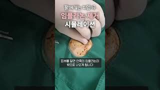 팔에 넣는 피임기구 임플라논은 어떻게 뺄까?