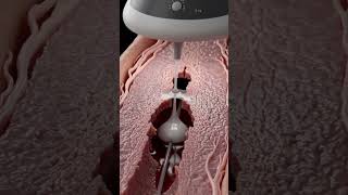 Cyanoacrylate Glue Catheter Bonds a Refluxing Leg Saphenous Vein Shut