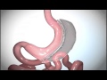 Gastric Sleeve Surgery ǀ Who Should Perform Your Vertical Sleeve Gastrectomy?