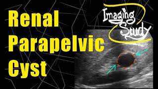Renal Parapelvic Cyst - Bosniak Grade-I || Ultrasound || Case 83