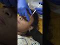 First sitting difference. Under eye dark circles reduced. Wait for final results after 3 sittings