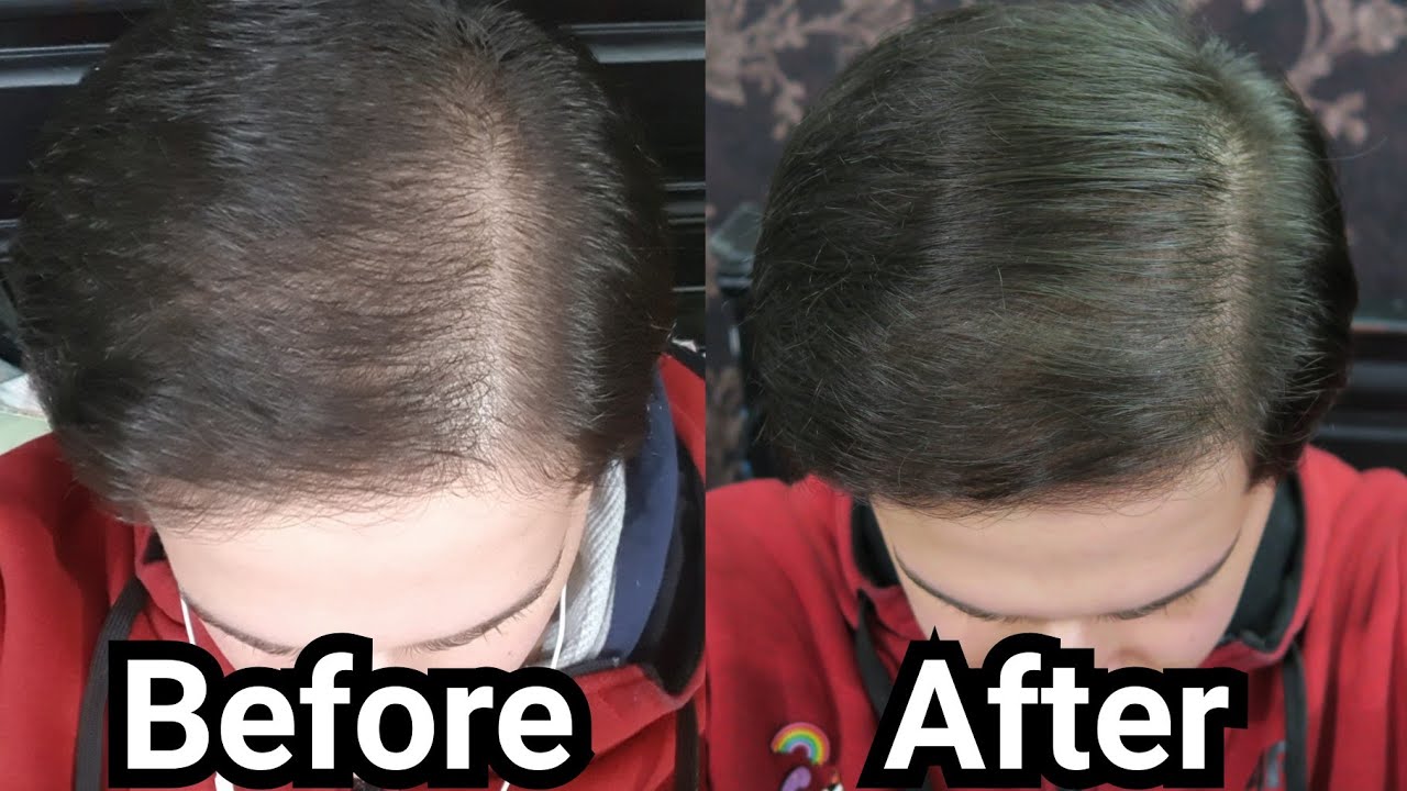 1 Year Of Using Rosemary Oil For Hair Loss My Results W Pictures Before After How To Use Youtube