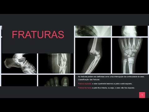 Vídeo: Como fornecer primeiros socorros para um osso quebrado: 8 etapas