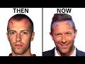 Chris Martin's Hair Transplant (Coldplay) | Plastic Surgery Analysis